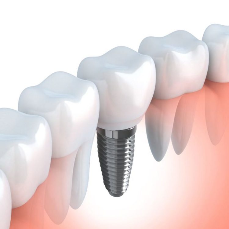 Implantologia-dentale-catania