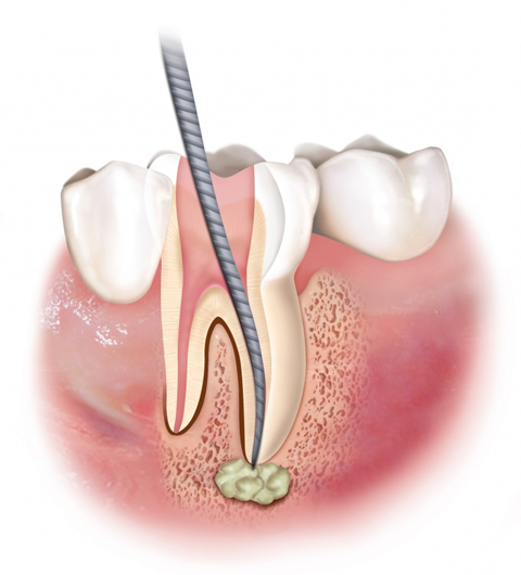 endodonzia-catania